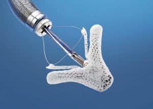 citrus-cardiology-mitraclip-mitral-valve-device MitraClip device used for mitral valve repair at Citrus Cardiology Consultants